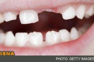 از دندان‌های شیری محافظت کنید