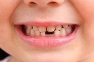دندان های کودکان ایرانی خراب تر از استاندارد جهانی است 