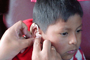 پیوند به هنگام گوش داخلی، امیدی برای درمان ناشنوایی کودکان