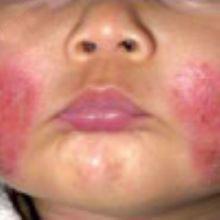 اگزما در کودکان و نوزادان