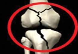 پوكی‌استخوان ناشی از تغذیه نادرست كودكی 